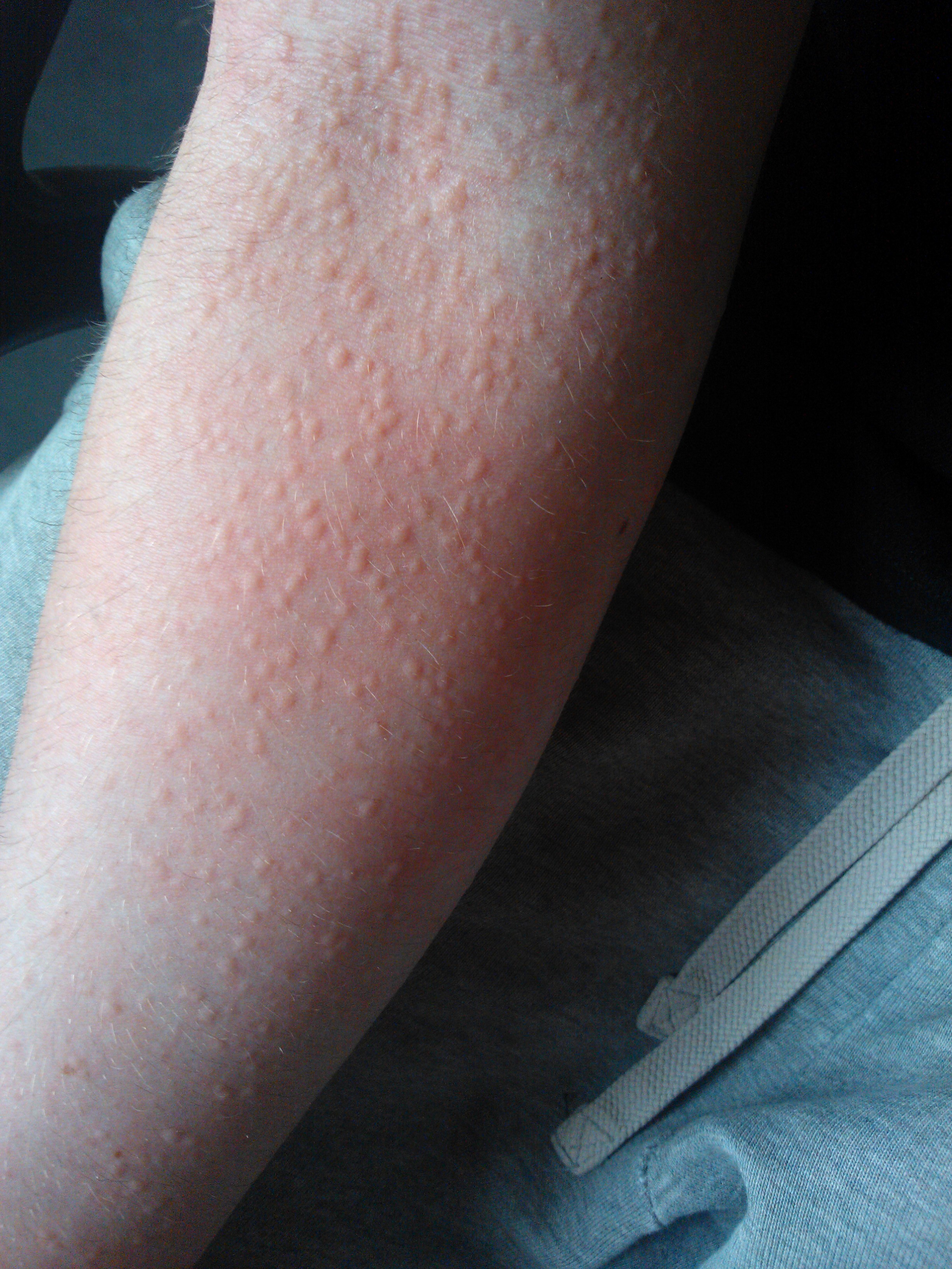 Homeopathic treatment for chronic Urticaria and allergic hives